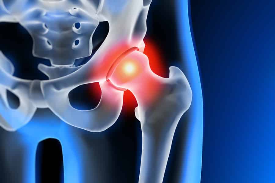 Hip Joint, Total Hip Replacement, Anterior Approach Hip Replacement